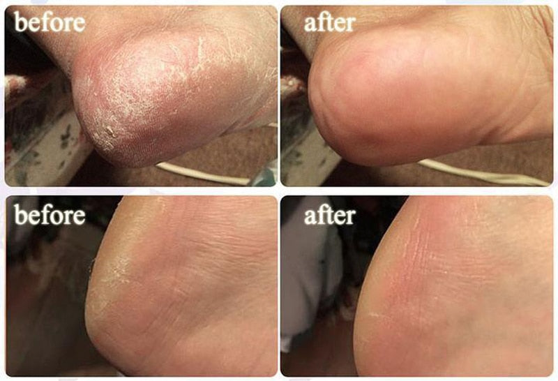 SPA tabletas efervescentes para remojar los pies con jengibre, hinchazón de los pies, Edema y dolor en el tobillo
